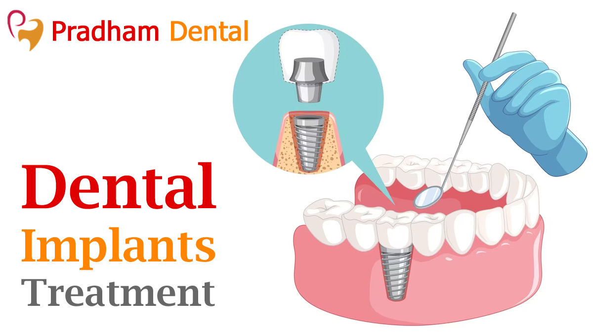 dental implants treatment in Hyderabad